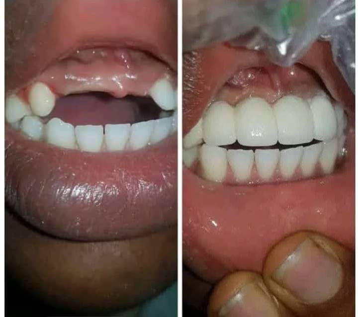 Tooth Replacement at Excellent Smile Dental Services