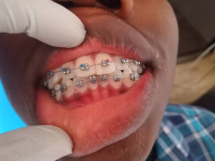 Orthodontic Treatment at Excellent Smile Dental Services